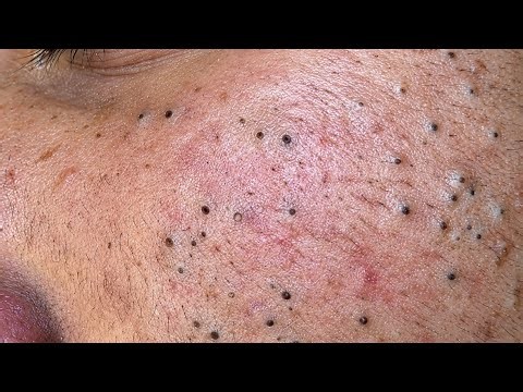 Ultimate Deep Facial Cleansing | Acne extraction & Blackheads and Whiteheads Removal