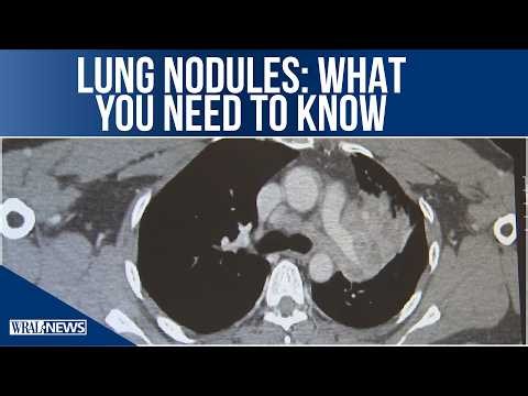 HEALTH MINUTE: What to know about lung nodules