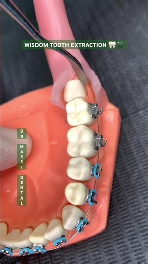 WISDOM TOOTH EXTRACTION 🦷😬