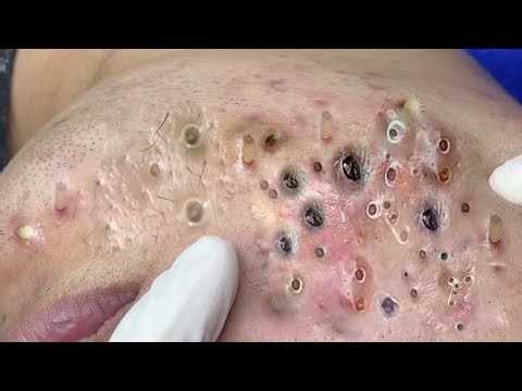 Extreme Blackhead Removal – Deep Pore Acne Cleaning With Satisfying Results Relaxing Music - 318906