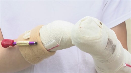 Missouri teen loses hand, several fingers in fireworks accident