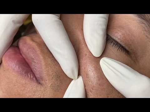 Severe Congested Acne in a Young Man Who Stays Up Late Gaming | Loan Nguyen Acne Treatment Official