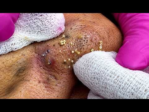 NEW 2026 Satisfying Pimple Removal Compilation | Acne Extraction#10325