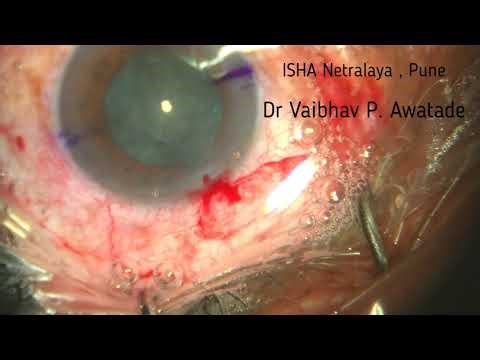 Phaco , Direct Chop , Vivity Toric IOL , 31/12/25