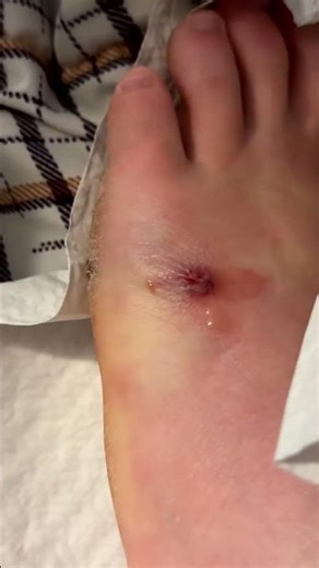 Splinter stuck in foot for about 2 weeks, finally got it out Watch till the end for a surprise