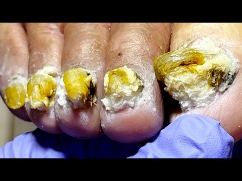 The Onychomycosis Has Spread To All Nails, So Trim Them Carefully【Xue Yidao】