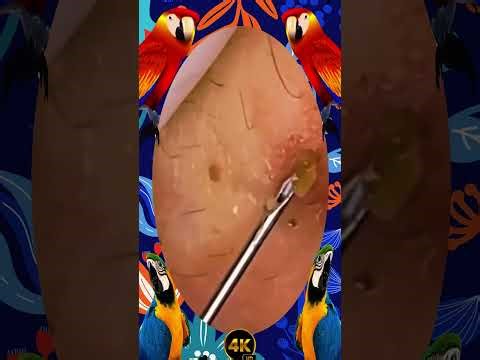 Blackheads Removal | Acne Treatment and Very Satisfying Satisfying Pimple pop #blackheads