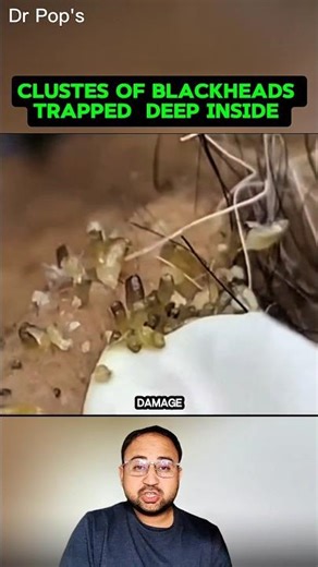 Deep Cluster Blackheads… So Many Come Out at Once! 😳 #shorts