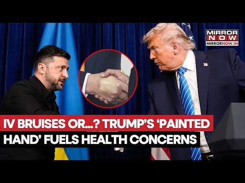 Donald Trump Health Buzz: Concealer Or IV Bruises On Hand During Zelenskyy Meet? Watch
