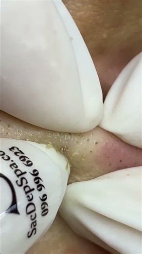 Sac Dep Spa #acne #acnetreatment #asmrrestoration #blackheadremoval #facialtherapy #6865 #blackheads