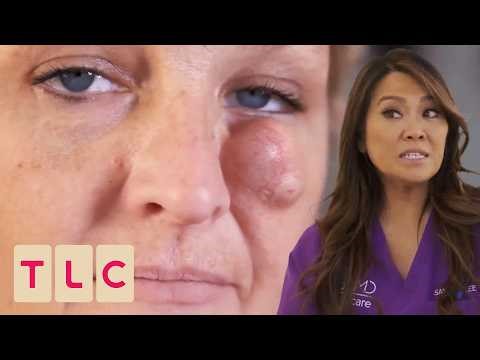 Dr. Lee Removes Cyst Which Has Blocked Patient's Vision | Dr. Pimple Popper