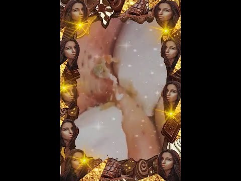 Blackheads Removal | Acne Treatment and Very Satisfying Satisfying Pimple pop #blackheads