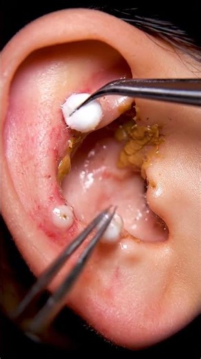 Brave ear pimple removal #satisfying #blackheadcaique #pimplepopping