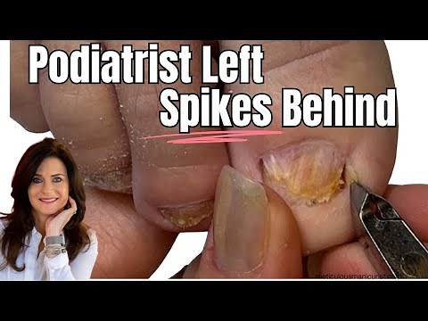 Ingrown Toenail Don't Try this at Home