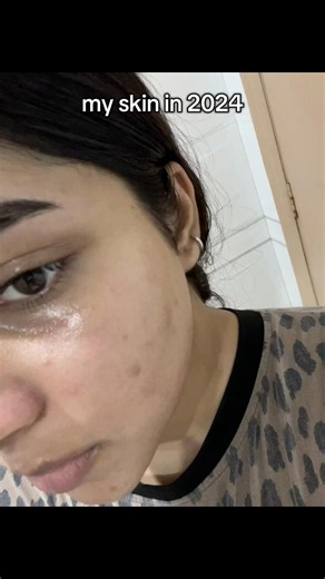My Acne Transformation: From 2024 to Glass Skin in 2026