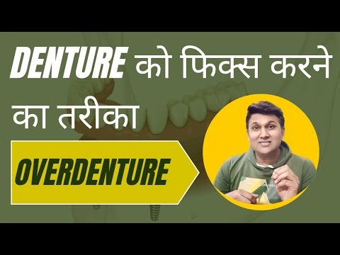Kaise Loose Denture Ko Fix Kare ? || Overdenture (in Hindi)