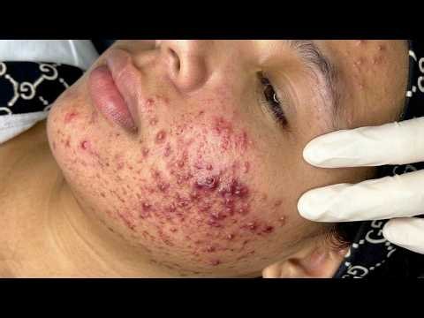 Cystic acne extraction | Pimple popping | Blackhead Removal | Cyst popping this week #5