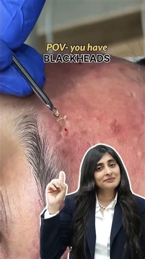 Nose Blackhead Removal — Extreme Macro Extractions