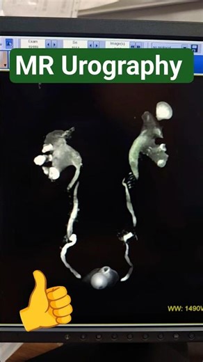 MRI Urography | #radiology #shortsfeed #mriscan #shorts #viral #trending