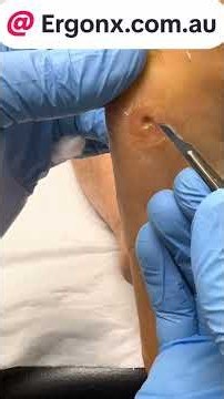 Painful Corn Removal Relief for Hardworking Feet #Podiatry #FootCare