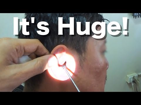 Removing A HUGE HARD Earwax Stuck in Man's Ear