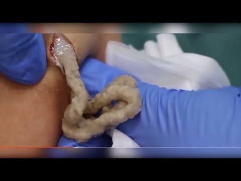 Satisfying Pimple Popping & Cyst Extractions - 117