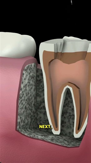 Root Canel Treatment