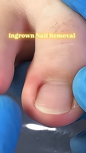 Swollen nail? 😣💅 That’s your body’s way of saying something’s wrong! When the nail grows into the skin, it causes irritation, swelling, and pain. 🦶🔥 Early removal helps stop infection and brings instant relief. Don’t wait — take care before it gets worse! ✨ #swollennail #ingrownnail #ingrownnailremoval #painrelief #toenailcare #footcare #nailhealth #podiatryusa #satisfyingremoval #nailfix #footpain #beforeandafter #healthyfeet #nailtransformation #painfreefeet | Podiatrist-SJ