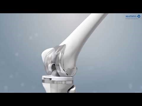 Mathys: balanSys BICONDYLAR Knee System – Design Features