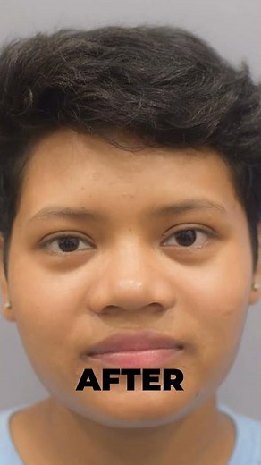 PRP for Hair Loss Treatment Results | Before & After PRP Treatment at CARA