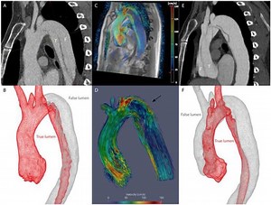 4D flow MRI of type B dissection with later retrograde progression to type A dissection in Marfan: a case report