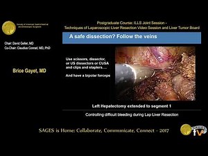 Controlling Difficult Bleeding During Lap Liver Resection • Video • MEDtube.net