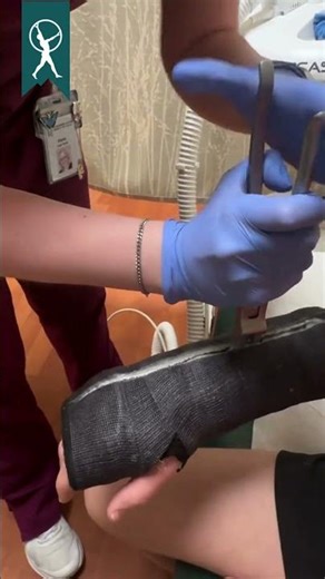 Watch as we remove a cast! #armcast #castremoval #casttech