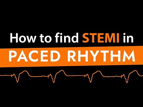 How to find STEMI in Paced Rhythm (feat. Dr Sgarbossa)