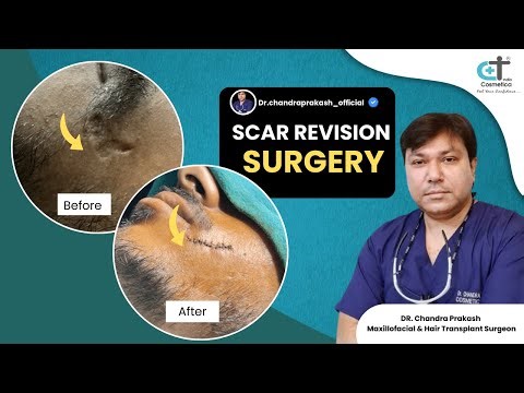 Scar Revision Surgery | Procedure Explained | cosmetica India #skincare #surgery #viralvideo
