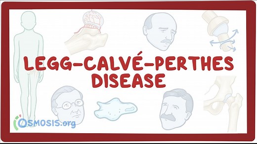 Legg-Calve-Perthes disease: Video, Causes, & Meaning | Osmosis