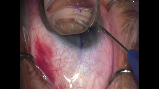 NEW Nova Eye: iTrack Advance GLaucoma surgery | Nova Eye Medical