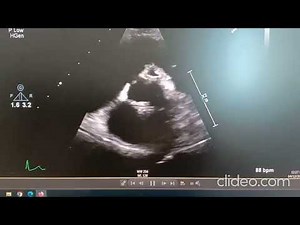 Amplatzer Closure of perforated anterior mitral valve leaflet