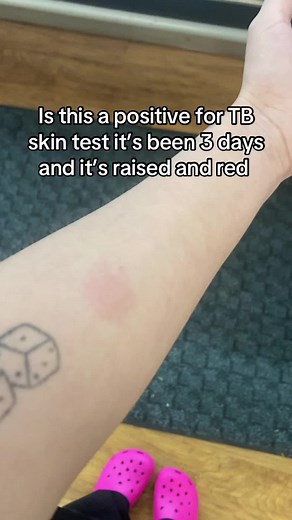 Understanding TB Skin Test Reactions