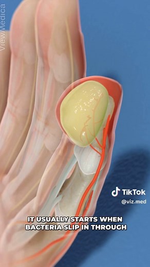Understanding Felon Infections in the Fingertip