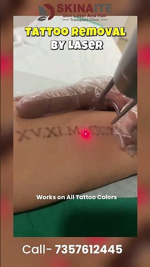 How to Remove Tattoos | Laser Tattoo Removal Treatment for All Skin Types | Skinaite Clinic