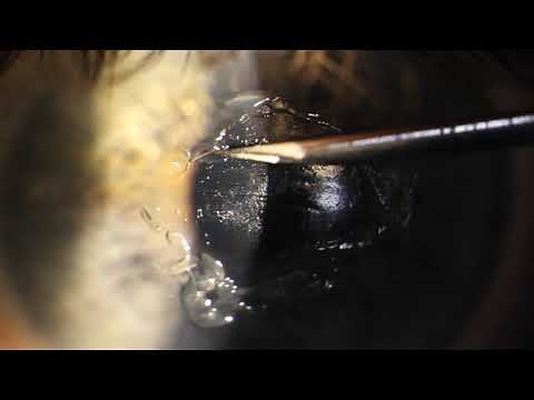 Cornea Debridement of EBMD with a 21-Gauge Needle