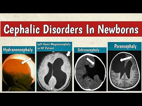 Cephalic Disorders In Newborns | Congenital Brain Malformations Radiology