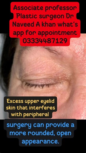 #eyelidsurgery #plasticsurgery #blepharoplasty #cosmeticsurgery #facelift #rhinoplasty #plasticsurgeon #liposuction #tummytuck #eyelidlift #beforeandafter #eyelid #oculoplastics #botox #necklift #breastaugmentation #beauty #surgery #sulambibir #browlift #doubleeyelidsurgery #nosejob #doubleeyelid #eyelidexpert #g #breastlift #abdominoplasty #oculoplasticsurgeon #facialplasticsurgery | Dr Naveed A Khan Plastic Surgeon