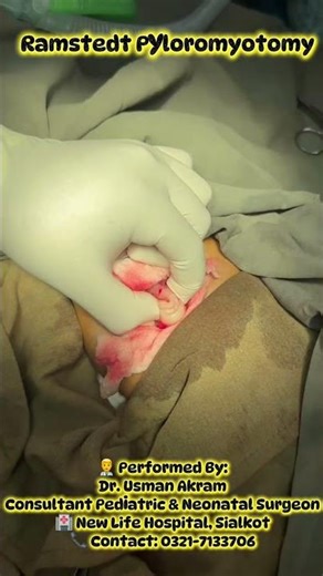 Ramstedt pyloromyotomy