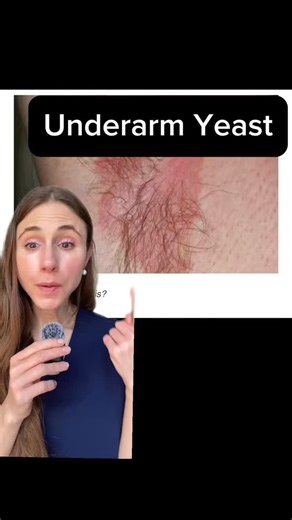 Andrea Suarez, MD, FAAD on Instagram: "Underarm yeast rash explained #skinrashes #skinhealth #dermatologist"