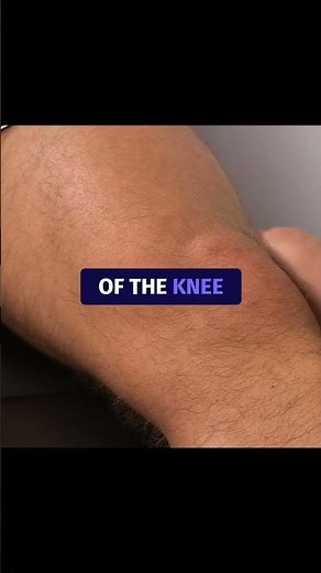 Brush / Stroke / Bulge / Swipe Test⎟Knee Swelling