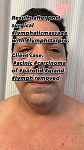 Results after post surgical #lymphaticmassage with #lymphstarpro. Client case: #acinic #carcinoma of #parotid #gland #lymph removed. . Understanding Lymphatic Drainage Therapy Post-Parotid Gland Surgery When a person undergoes surgery for acinic cell carcinoma of the parotid gland, the procedure often involves removing part of the gland and surrounding lymph nodes to prevent the spread of cancer. This surgical intervention can significantly affect the normal lymphatic circulation in the neck and