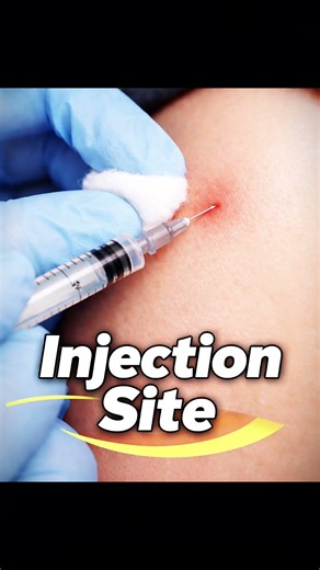 “Best Injection Site in 10 Seconds!”|“Stop Injecting Wrong! Try This Site #inject #tramadol #nursing