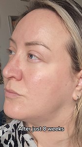 Target cystic acne, breakouts & blackheads with powerful active ingredients that *actually* work, and see visible in just 8 weeks ✨ Use code CLEAR50 at checkout to get 50% off your first 3 months (now £12.50 was £24.99). | Dermatica